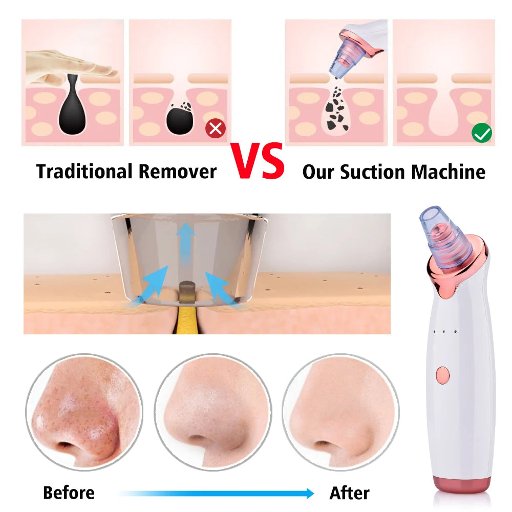 SILK ROLLA Blackhead Remover Vacuum Pore Cleaner Device