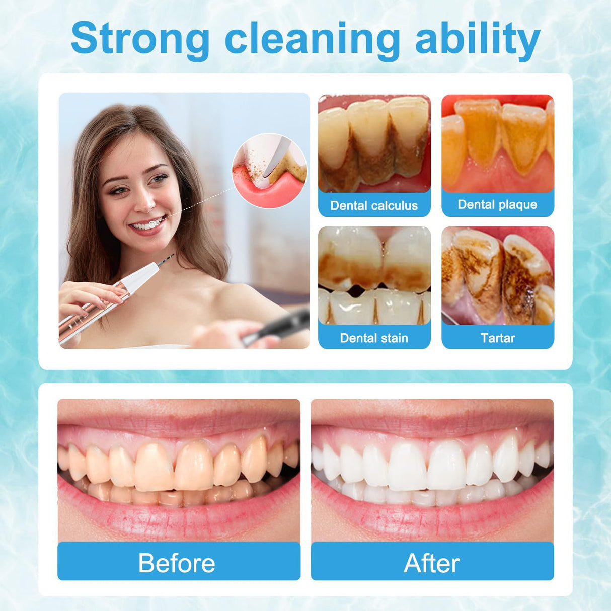 Ultrasonic Dental Scaler Kit - Teeth Cleaner & Tartar Remover