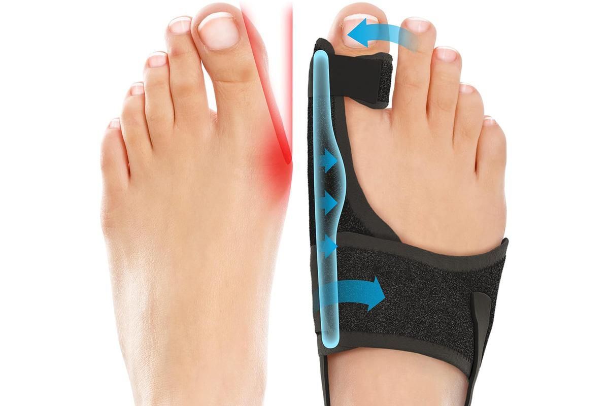 Adjustable Orthopaedic Bunion Corrector